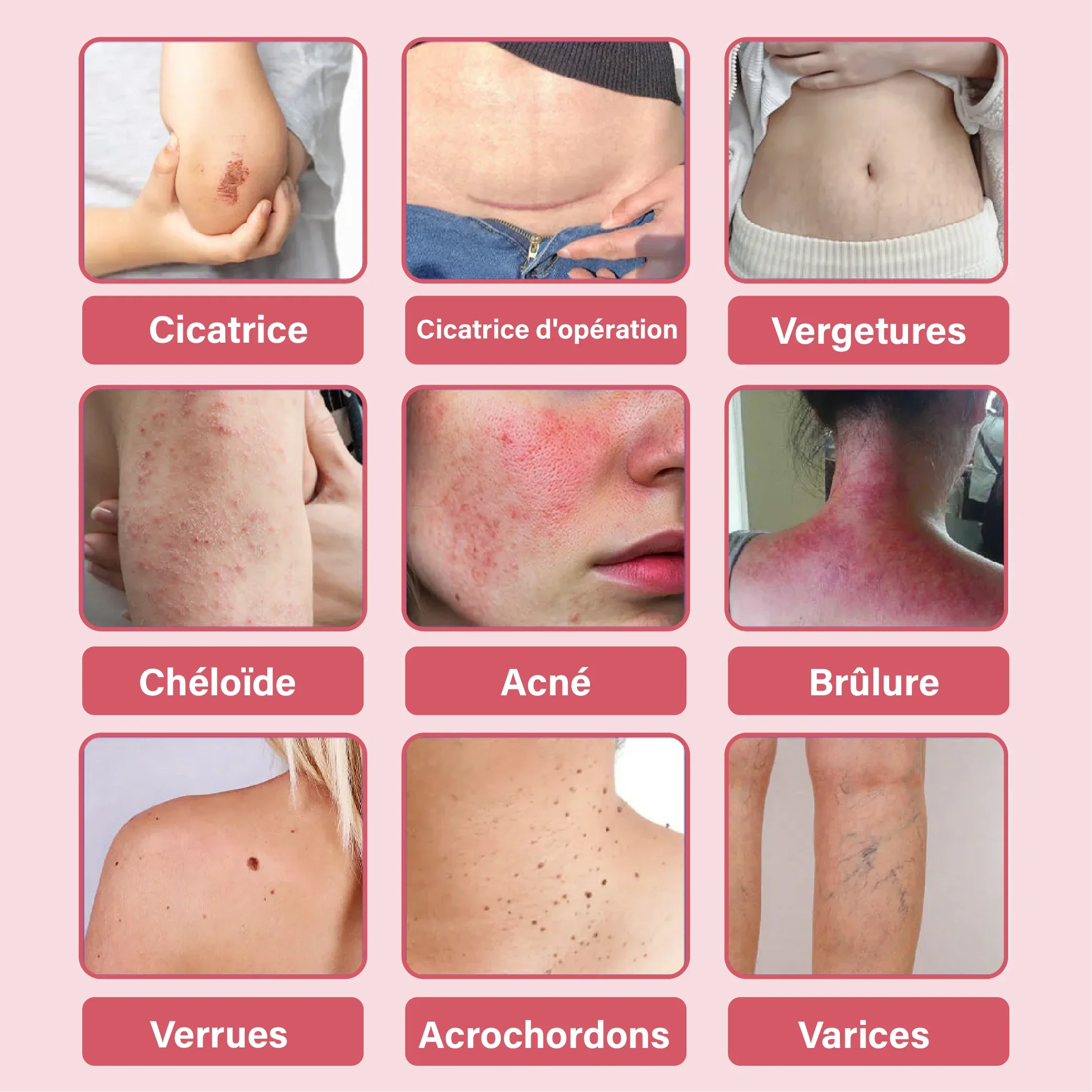 Le mensonge des crèmes anti-cicatrices : pourquoi 99 % des traitements ne fonctionnent pas (et celui-ci, enfin, oui !)