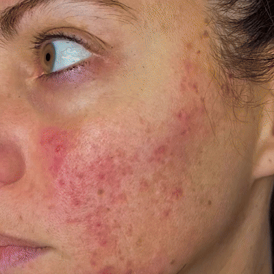 HyperFade ™ - dischi di carnagione anti -taco e luminosi in 21 giorni