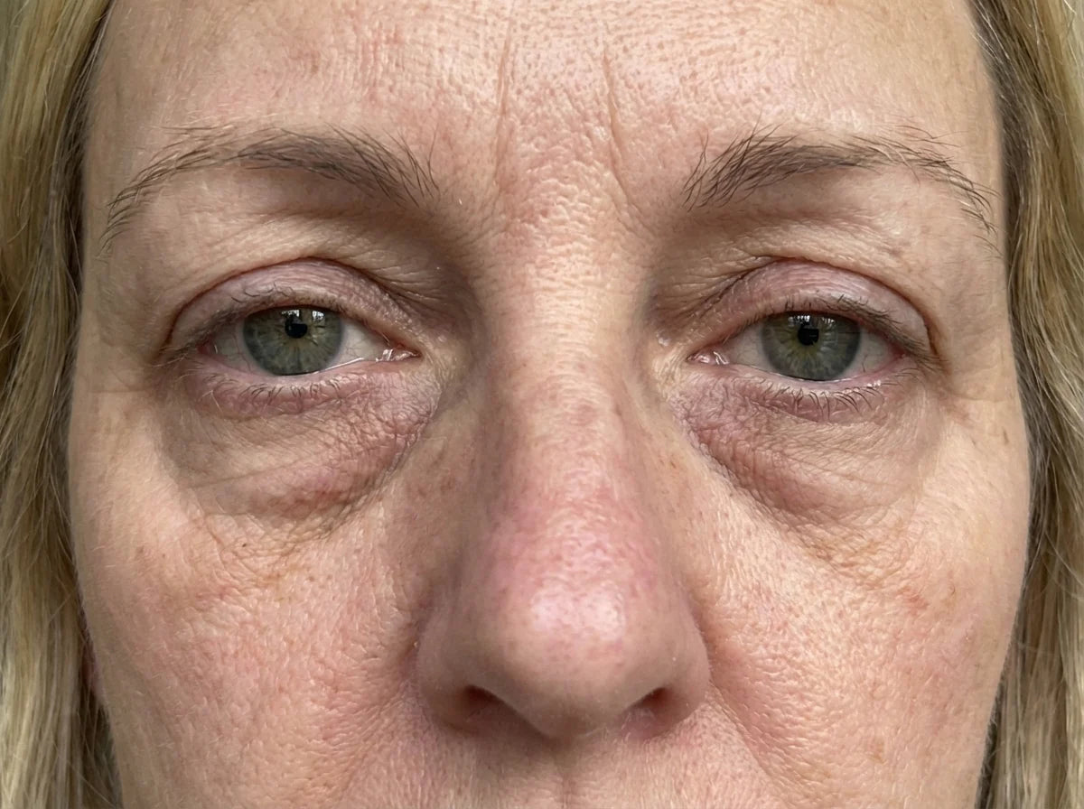 Under-eye bags before Lumirae