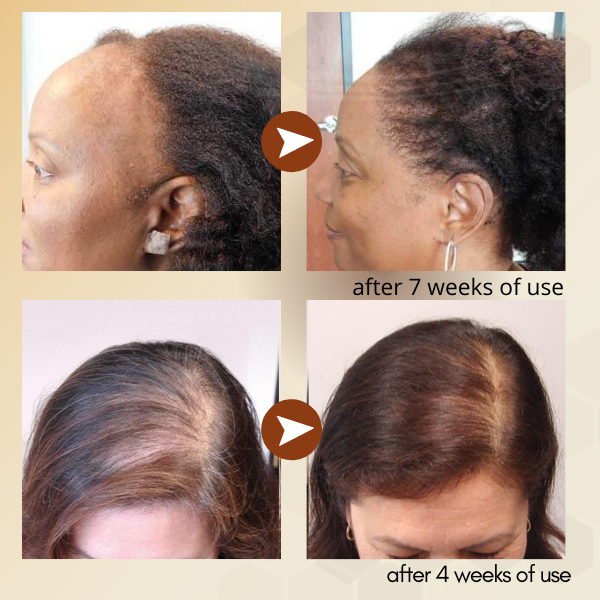 Malaiyca™ ReGrowth Ingwerspray